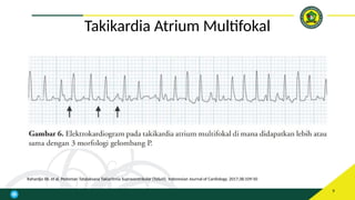 referat supraventrikular takikardia atau svt | PPTX