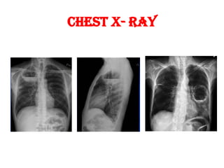 Chest X- Ray
 