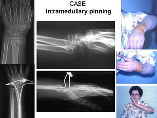 Percutaneous pinning of distal radius (old technique) | PDF