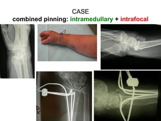Percutaneous pinning of distal radius (old technique) | PDF