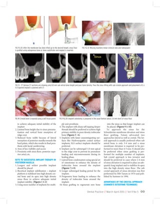 Dental Practice // March-April 2013 // Vol 11 No 5 00
to achieve adequate initial stability of the
implant
2. Limited bone height due to sinus pneuma-
tisation and vertical bone resorption of
ridge crest
3. Reduced bone width because of lateral
resorption of posterior maxilla towards the
hard palate, which also results in final pros-
thesis with facial cantilevering
4. Area of less visibility and access
5. Proximity with sinus floor, posterior supe-
rior artery etc.
KEYS TO SUCCESSFUL IMPLANT THERAPY IN
POSTERIOR MAXILLA
1. Longest and widest possible implant
should be placed
2. Bicortical implant stabilization – implant
platform is stabilized into high density cre-
stal bone and its apex into high density
sinus floor to achieve adequate initial
implant stability. (Figures 1 & 2)
3. Using more number of implants for multi-
ple unit prosthesis
4. The implant with sharp self tapping deeper
threads should be preferred to achieve high
primary stability in poor density trabecular
bone (Figures 3 - 6).
5. Implants with faster osseointegrating sur-
faces like Hydroxyapatite coated surface
implants; SLA surface implants should be
preferred.
6. Implant can be submerged 1.0 mm apical
to the ridge crest to prevent its premature
loading and micromovements during its
healing phase.
7. Lateral bone condensation using special set
of osteotomes to enhance the density of
trabecular bone around the implant
(Figures 7 & 8).
8. Longer submerged healing period for the
implant.
9. Progressive bone loading to enhance the
density of trabecular bone around the
implant.
10. Sinus grafting to regenerate new bone
into the sinus so that longer implant can
be placed. (Figures 9 & 10).
To approach the sinus for the
Schneiderian membrane elevation and sinus
floor grafting, Tatum advocated two
approaches lateral as well as crestal. The lat-
eral approach is usually preferred when sub
antral bone is only 3-4 mm and a sinus
membrane elevation is required to be per-
formed to more than 4-5 mm. It should also
be preferred when sinus grafting is per-
formed for multiple number of implants.
Sub crestal approach is less invasive and
should be preferred in cases where 2-4 mm
of sinus elevation is required to place an ade-
quately long implant and to stabilize its apex
into the high density sinus floor. The sub
crestal approach of sinus elevation was first
performed by Hilt Tatum in 1974 and pub-
lished by Summer in 1994.
ADVANTAGES OF THE CRESTAL APPROACH
(SUMMER’S OSTEOTOME TECHNIQUE)
FIG 18: Crestal bone is exposed using a soft tissue punch. FIG 19 & 20: Implant osteotomy is prepared in the usual fashion about 2.0 mm short of sinus floor.
FIG 13 - 17: Various CT sections are showing only 8.0 mm sub-antral bone height and poor bone density. Thus the sinus lifting with sub-crestal approach and placement of 6 x
11.5 tapered implant is planned with CT.
FIG 11 & 12: Missing maxillary molar (clinical view and radiograph)FIG 9 & 10: After the membrane has been lifted up to the desired height, sinus floor
is grafted using autogenous bone or bone substitutes and implant is inserted.
 
