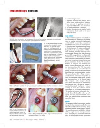 Dental Practice // March-April 2013 // Vol 11 No 500
implantology section
1. Less invasive procedure.
2. Improves maxillary bone density, which
allows greater initial stability of implants.
3. Less amount of grafting material is
required to fill the lifted sinus membrane.
4. No barrier membrane is required
5. Limited flap elevation is required which
maintain the blood supply to the lateral
wall of the sinus.
CASE REPORT
A 48 year old female patient, medically fit for
the implant therapy, reported for the replace-
ment of missing tooth no.26. Radiographs
and dental CT revealed the availability of
only 8.0 mm bone under the maxillary sinus.
A DentaScan also showed poor bone density
at the implant site. To place an adequately
long implant with adequate initial stability, a
sinus elevation procedure with sub-crestal
approach was planned. The ridge form was
good and the marginal tissue was thick, stable
and keratinised so the implant placement
using tissue punch was planned. The osteoto-
my for the implant was prepared in the usual
fashion but 2.0mm short of the sinus floor.
Further, an adequate size osteotome was
used to fracture up the sinus floor and lift up
the sinus membrane. The PRF plug which
was prepared from the venous blood of the
patient was introduced into the osteotomy to
guard the sinus membrane against rupture.
The bone substitute (HA + β-tcp) was intro-
duced into the osteotome and pushed up
using the osteotome which further elevated
the sinus membrane to the desired height.
The implant with deeper threads
(6x11.5mm) was then placed and stabilized
into the sinus floor. Because the implant is
stabilised bicortically it achieved a primary
stability of more than 35Ncm and the
implant was left to heal with open protocol.
The implant is restored in function after 4
month of open healing. The follow-up radi-
ograph after one year showed stable crestal
bone level and new bone regeneration into
the grafted sinus.
RESULT
The author practiced conventional implant
therapy in the posterior maxilla for years
where he used hundreds of varying design
root form implants in the posterior maxilla.
The poor bone density, availability of limit-
ed bone height (due to sinus pneumatiza-
tion) and high force factors forced him to
place the short length implant, submerging
FIG 21 & 22: After the osteotomy has been prepared 2.0 mm short of sinus floor, an adequate size osteotome is
used to fracture up the sinus floor and to lift up the Schneiderian membrane.
FIG 27: The use of mechanical driver
(torque ratchet) is showing that the
implant has achieved primary sta-
bility more than 35 Ncm because it
has been stabilised bicortically
FIG 28 & 29: Implant at the final position. Gingival former is inserted for
transgingival healing of the implant
FIG 23 & 24: The PRF (platelet-rich fibrin)
is prepared from the patient’s venous
blood which was withdrawn before
surgery and centrifuged in a table top
centrifuge machine. This fibrin is first
inserted into the prepared osteotomy
and pushed using osteotome to place it
under the sinus membrane. It provides a
protection to the membrane against
rupture during its further elevation and
grafting. It also enhances the bone
regeneration potential of the graft
material.
FIG 25 & 26: The bone substitute (HA + β-Tcp) is now used to graft the elevated sinus floor and implant is inserted
 
