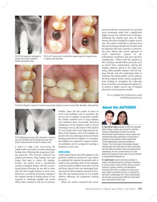 it apical to ridge crest, uncovering the
implant after more than 6 month submerged
healing time, following the progressive load-
ing protocols. This protocol required two
surgical procedures, long healing time and
longer time span to restore the implant.
Further, the author faced a considerable
number of implant failures with the conven-
tional protocol because he was able to place
only the short length implant in most cases.
Moreover, to avoid the premature loading of
the implant during its healing phase he was
required to submerge implant sub crestal
which often resulted in the loss of primary
stability. Since the last couple of years, to
avoid such problems and to maximize the
success rate of implant in posterior maxilla,
the Author switched over to long implants
and stabilized them bicortically. Bicortical
stabilization of the implant result in several
advantages such as placement of the implant
4-5 mm longer than usual, high primary sta-
bility of the implant, most of the implant are
placed with non submerged protocol, shorter
healing period for the implant (3-4 months),
less implants are required to support multiu-
nit prosthesis and no progressive loading is
required in most cases.
CONCLUSION
Author placed more than 200 implants in the
posterior maxilla in a period of 3 years where
he stabilized the implant bicortically with or
without sinus grafting. Most of the implants
achieved primary stability more than 35 Ncm
and hence placed with non submerged heal-
ing protocol. Most implants restored in func-
tion after the healing period of 3-4 months
without following any progressive loading
protocol.
When the author compared this newer
protocol with the conventional one, he found
more promising results and a significantly
higher success rate with the newer technique.
Stabilizing the implant apex into the high
density sinus floor resulted in a higher success
rate. The author would like to mention here
that this technique should only be performed
by clinicians who have expertise in perform-
ing sinus lifting with crestal approach to
avoid inadvertent rupture of the
Schneiderian membrane and post operative
complication. Others with less expertise in
this technique should follow protocols such
as lateral bone condensation, placing the
implant platform apical to the ridge crest,
using widest possible implant with self tap-
ping threads and self condensing body to
maximize the initial stability and to enhance
the bone implant surface contact, progressive
bone loading to strengthen the trabecular
bone around the osseointegrated implant etc.
to achieve a higher success rate of implant
placement in the posterior maxilla.
For a complete list of references, email:
info@dental-practice.biz
Dr. Ajay Vikram Singh graduated in 2003 from Saraswati
Dental College, Lucknow, and received PG. certificate
training in Implantology from India. He received
advanced level implant training at various centers and
continuing education programmes in USA and also in
Australia. He has authored a dental implant book
“Clinical Implantology” published worldwide by
“Elsevier”. He is the founder of International Implant
Training Centre (IITC), Agra where he trains several den-
tists from India and abroad in basic and advanced level
implantology. He runs a private practice at Dr. Ajay
Dental Clinic & Research Centre, Agra. He can be reached
at drajaydentalclinic@gmail.com.
Dr. Sunita Singh received continuing education in
esthetic and implant dentistry, and fixed orthodontics
at various centers in India and USA. She has received
training in Cosmetic Dentistry from Washington
University (USA). She is a member of various presti-
gious implant associations and has co-authored the
text book in implantology title “Clinical Implantology”.
She has been practicing since 2003 at Dr. Ajay Dental
Clinic and Research Center, Agra.
About the AUTHORS
Dental Practice // March-April 2013 // Vol 11 No 5 00
FIG 31 & 32: Clinical view 4 month after implant insertion. Gingival former
is replaces with abutment.
FIG 35: Radiograph one year after restoration is showing
new bone formation into the grafted sinus and main-
tained crestal bone level around the implant collar.
FIG 33 & 34: Implant is restored in function using cement retained zirconium crown (CZAR- Monolithic, Katara Dental)
FIG 30: Post operative radiograph in
showing bicortically stabilized
implant and grafted sinus.
 