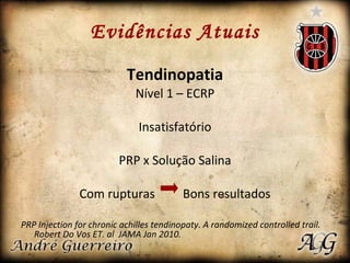 Evidências Atuais Tendinopatia Nível 1 – ECRP Insatisfatório PRP x Solução Salina Com rupturas  Bons resultados PRP Injection for chronic achilles tendinopaty. A randomized controlled trail. Robert Do Vos ET. al  JAMA Jan 2010.  