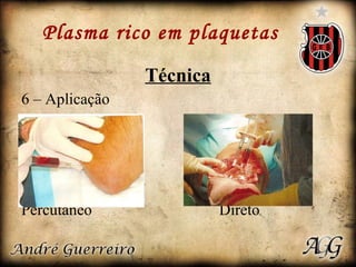 Plasma rico em plaquetas Técnica 6 – Aplicação Percutâneo  Direto 