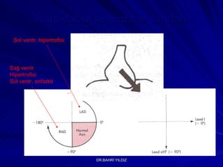 Kardiyak aksın normal sınırları Sol ventr. hipertrofisi Sağ ventr. Hipertrofisi Sol ventr. enfarktı 