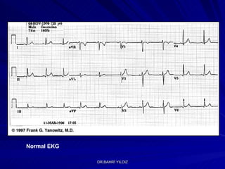 Normal EKG 