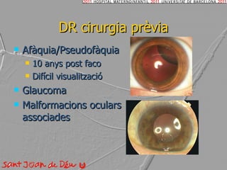 DR cirurgia prèvia Afàquia/Pseudofàquia 10 anys post faco Difícil visualització Glaucoma Malformacions oculars associades 