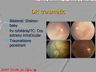 DR traumàtic Bilateral: Shaken-baby Rx orbitària/TC: Cos estrany intraOcular Traumatisme penetrant 