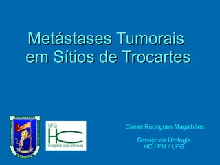 Metástases Tumorais  em Sítios de Trocartes Daniel Rodrigues Magalhães Serviço de Urologia HC / FM / UFG 