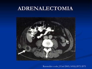 ADRENALECTOMIA  Metástase de carcinoma de pulmão Rassweiler e cols. J Urol 2003; 169(6):2072-2075 