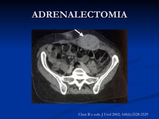 ADRENALECTOMIA Metástase de pequenas células de carcinoma de pulmão Chen B e cols. J Urol 2002; 168(6):2528-2529 