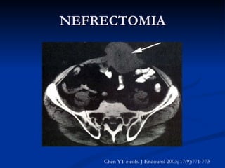 NEFRECTOMIA Metástase carcinoma renal Chen YT e cols. J Endourol 2003; 17(9):771-773 