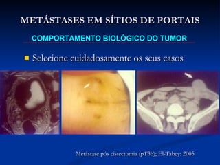 METÁSTASES EM SÍTIOS DE PORTAIS Selecione cuidadosamente os seus casos COMPORTAMENTO BIOLÓGICO DO TUMOR Metástase pós cistectomia (pT3b); El-Tabey: 2005 
