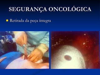 SEGURANÇA ONCOLÓGICA Retirada da peça íntegra  