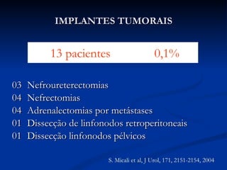 13  pacientes  0,1% 03  Nefroureterectomias 04  Nefrectomias 04  Adrenalectomias por metástases 01  Dissecção de linfonodos retroperitoneais 01 Dissecção linfonodos pélvicos IMPLANTES TUMORAIS S. Micali et al, J Urol, 171, 2151-2154, 2004 