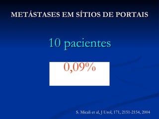 METÁSTASES EM SÍTIOS DE PORTAIS 10 pacientes 0,09% S. Micali et al, J Urol, 171, 2151-2154, 2004 