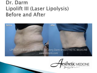 Dr. DarmLipolift III (Laser Lipolysis)Before and After 