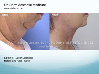 Dr. Darm Aesthetic Medicine www.drdarm.com Lipolift III (Laser Lipolysis) Before and After - Neck 