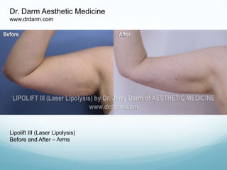 Dr. Darm Aesthetic Medicine www.drdarm.com Lipolift III (Laser Lipolysis) Before and After – Arms 