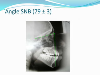 Angle SNB (79 ± 3)
 