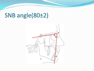 SNB angle(80±2)
 