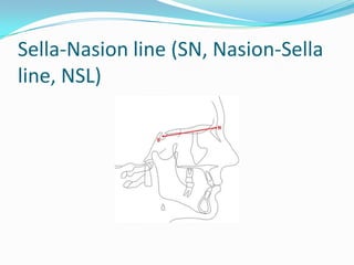 Sella-Nasion line (SN, Nasion-Sella
line, NSL)
 