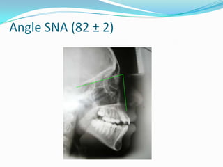 Angle SNA (82 ± 2)
 