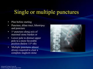 Puncture Line PCNL - the Perfect Puncture | PPT