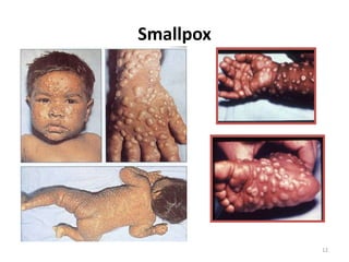 12Smallpox