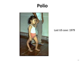 14PolioLast US case: 1979