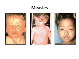 15Measles