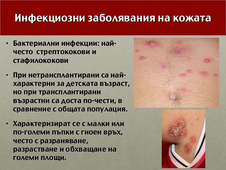Кожни проблеми при трансплантирани пациенти - д-р Каляшева