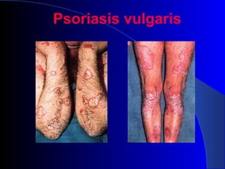 Psoriasis vulgaris
 