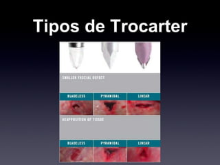 Tipos de Trocarter 