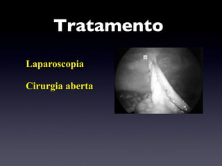 Tratamento  Laparoscopia Cirurgia aberta  