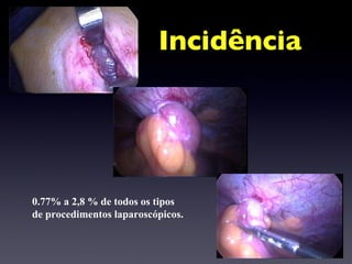 Incidência 0.77% a 2,8 % de todos os tipos  de procedimentos laparoscópicos. 