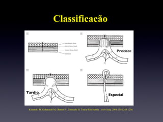 Classificacão Kusunoki M, Kobayashi M, Ohmori Y, Tonouchi H. Trocar Site Hernia .  Arch Surg.  2004;139:1248-1256. Pr Precoce Tardio Tardiao E Especial 