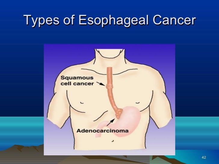 Esophageal Cancer esophageal-cancer
