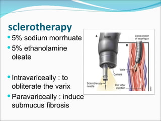 sclerotherapy 5% sodium morrhuate 5% ethanolamine oleate Intravariceally : to obliterate the varix Paravariceally : induce submucus fibrosis 