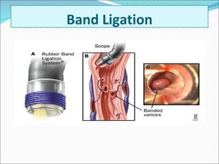 Alternative to sclerotherapy Fewer rebleeding episodes Fewer endoscopic interventions Lower procedure related mortality and over all mortality Band Ligation 