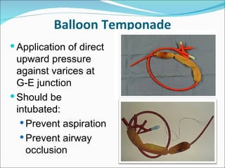 Balloon Temponade Application of direct upward pressure against varices at G-E junction Should be intubated: Prevent aspiration Prevent airway occlusion 