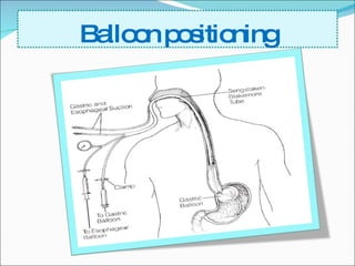 Balloon positioning 