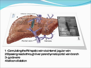 1 -Cannulating the Rt hepatic vein via internal jagular vein 2 – passing needle through liver parenchyma to portal vein branch 3- guide wire 4 balloon dilatation 