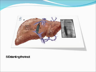 5 – stenting the tract 