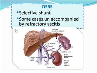 DSRS Selective shunt Some cases un accompanied by refractory ascitis 