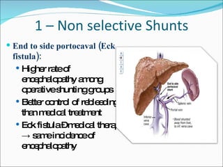 1 – Non selective Shunts End to side portocaval (Eck fistula): Higher rate of encephalopathy among operative shunting groups Better control of rebleeding than medical treatment Eck fistula – medical therapy -> same incidence of encephalopathy 
