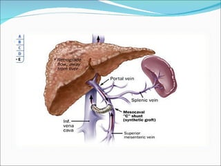 Interposition Mesocaval Shunt: Prosthetic – autogennous vien Avoid hilar dissection (future transplant) Shunt ligation in refractory post-op encephalopathy Drawback -> thrombosis (35%) 