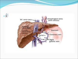 Coronary – Caval Shunt: Described in Japan in 1984 Interposition graft between L Gastric and inferior vena cava Little experience with this procedure 