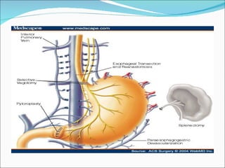 Esophagogastric Devascularization The most effective non-shunt operation for preventing variceal bleeding: Devascularization + transection + splenectomy Sugiura procedure 